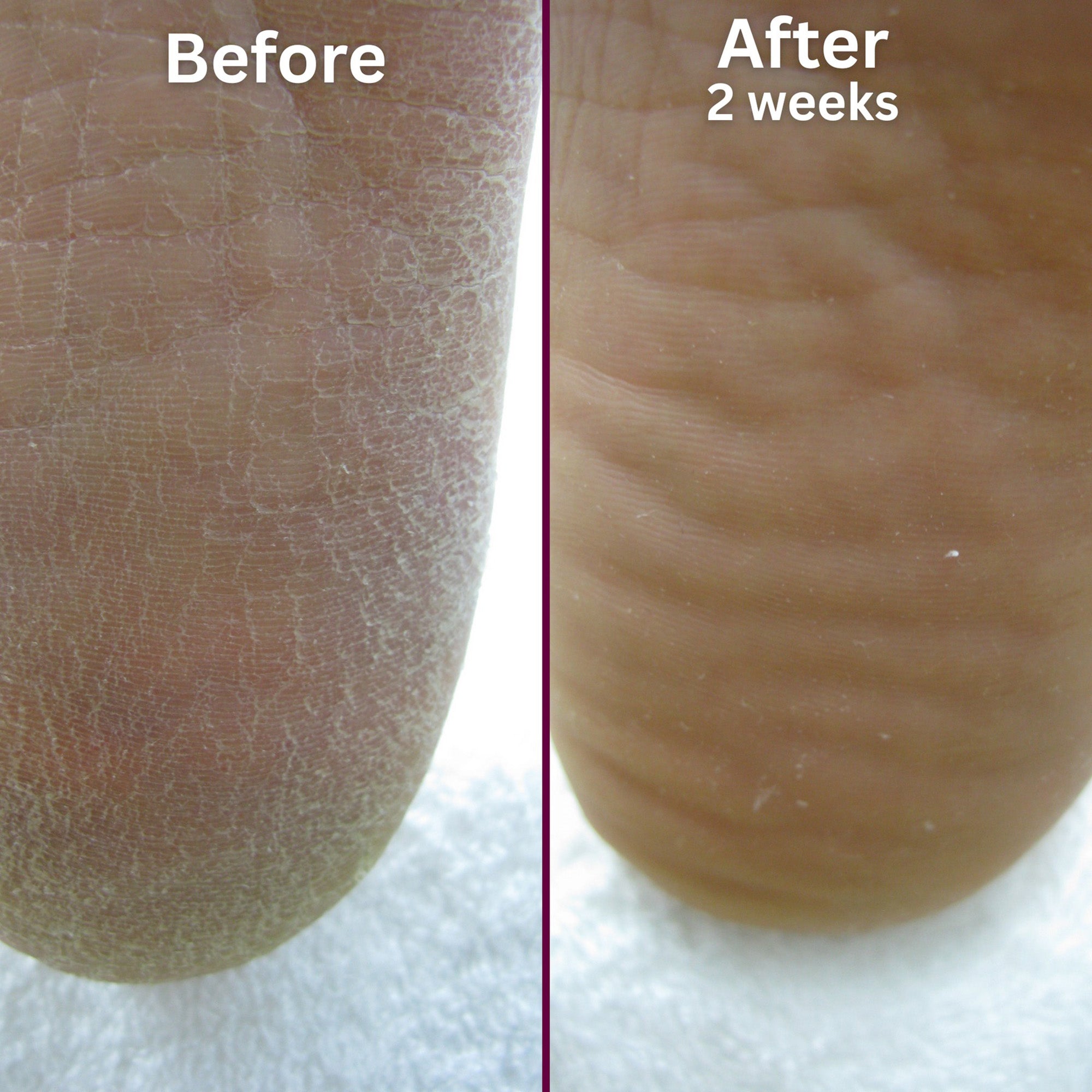 Footlogix Rough Skin Formula Mousse 7+ with Spiraleen 24131