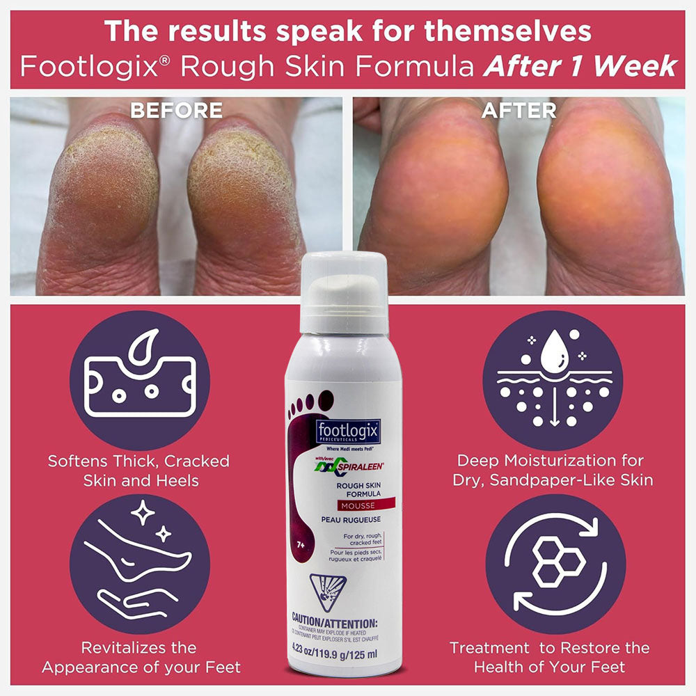Footlogix Rough Skin Formula (7+) Mousse  4.23 oz.  21131
