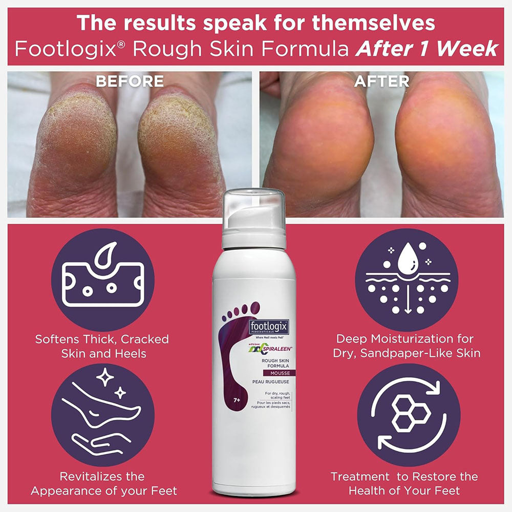Footlogix Rough Skin Formula (7+) Mousse 4.23 oz. 21131