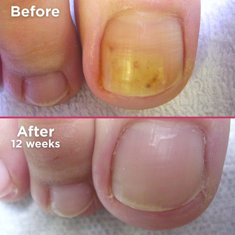 Footlogix Nail Tincture With Spiraleen 7T Spray 50 ml #22111