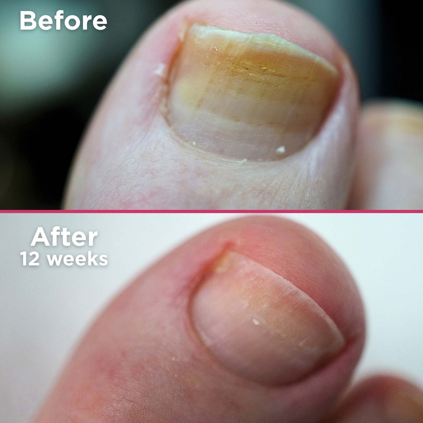 Footlogix Nail Tincture With Spiraleen 7T Spray 50 ml #22111