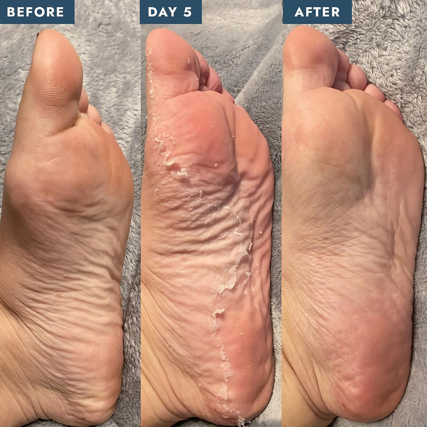 Voesh Peeling Socks W/Botanical Extracts VFP101LVR/02043
